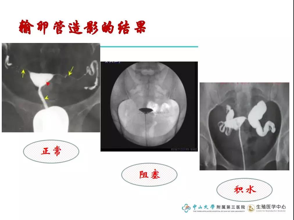 【微课笔记】四种方法抓住排卵期，生殖专家助你精子卵子鹊桥会