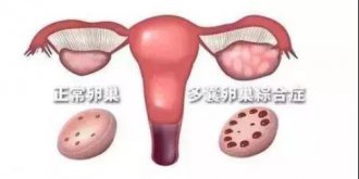 <b>【微课笔记】助孕专家邢卫杰助你应对多囊卵巢迎好孕</b>